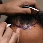 A close-up image shows a professional marking the hairline on a man's scalp with a surgical marker. This is likely part of the preparation process for a hair transplant procedure, where the planned hairline is drawn to guide the placement of hair grafts. The procedure aims to restore natural hair growth and improve the appearance of thinning or balding areas.