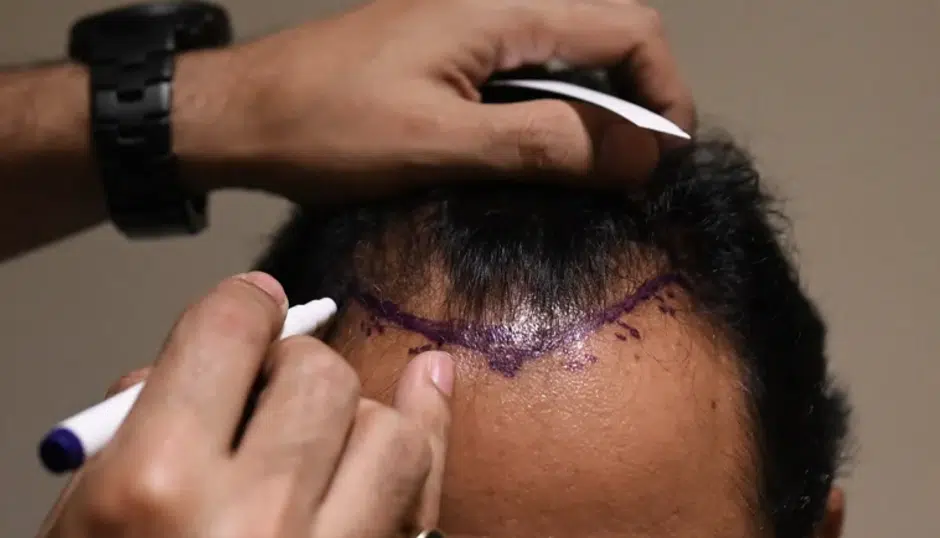 A close-up image shows a professional marking the hairline on a man's scalp with a surgical marker. This is likely part of the preparation process for a hair transplant procedure, where the planned hairline is drawn to guide the placement of hair grafts. The procedure aims to restore natural hair growth and improve the appearance of thinning or balding areas.